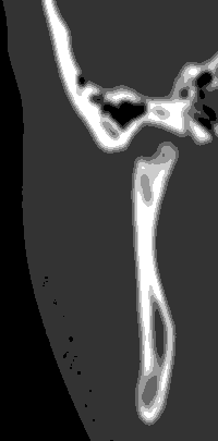 Figura 5 Tomografía Computada de ATM derecha, corte coronal. Se distingue la pronunciada pérdida de volumen condilar, ausencia de anatomía y aumento de mineralización del tejido óseo trabecular remanente.