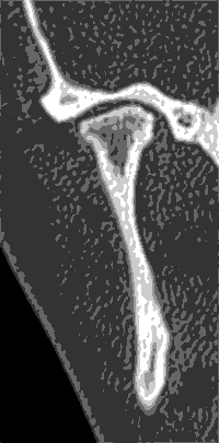 Figura 1 Tomografía computada de ATM derecha, corte coronal: Llama la atención la asimetría de formas óseas, caracterizada por el aplanamiento del apex condilar acompañado de irregularidad del contorno óseo cortical condilar.