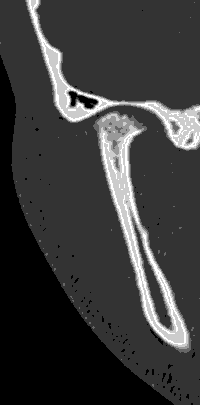 Figura 3: Tomografía computada de ATM derecha corte coronal: destaca la pérdida del volumen condilar, en relación a forma y tamaño de cavidad glenoida, acompañado de esfumado de corticales y aumento de la mineralización del tejido trabecular subyacente, sin compromiso del temporal.