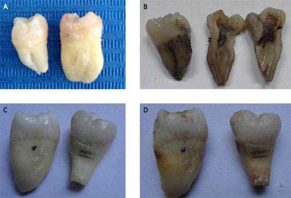 Figura 3 (A) Primer día de Doxiciclina en los conductos radiculares. (B) Cuarta semana de Doxiciclina en los conductos radiculares, con una muestra seccionada longitudinalmente. (C) Primer día de Doxiciclina + ácido ascórbico en los conductos radiculares. (D) Cuarta semana de Doxiciclina + ácido ascórbico en los conductos radiculares.