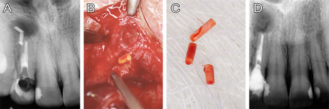 Figura 2 (A) radiografía periapical mostrando la persistencia del material obturador; (B) fragmento del cono de gutapercha adherido al colgajo mucoperióstico; (C) remoción de los fragmentos de gutapercha; (D) radiografía post-operatoria.