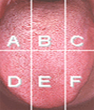 Figura 8 Índice de Recubrimiento Lingual de Winkel. Tomado de Roldan, Herrera y Sanz. Biofilm and the tongue: therapeutical approaches for the control halitosis. Clin Oral Invest 2003; 7: 189-197