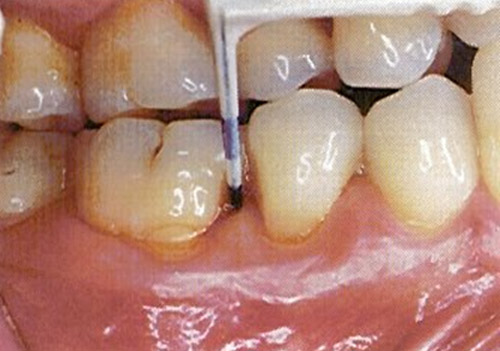 Figura 5 Sensor de sulfuros insertado en el saco periodontal. Tomado de Morita y Wang. Relationships of Sulcular Sulfide level to Severity of Periodontal Disease and BANA test. J. Periodontol 2001; 72:74-78.