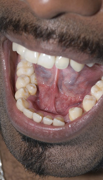 Fig 1 Fotografía Intrabucal que muestra la presencia de 2 órganos dentales supernumerarios erupcionados en la arcada inferior por lingual del lado derecho