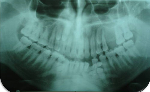 Fig 2 Radiografía panorámica del paciente en estudio, que muestra la presencia de múltiples órganos dentarios ubicados tanto en la arcada inferior como en la superior