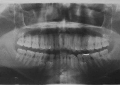 Fig 3 Radiografía panorámica del hermano del paciente en estudio, que muestra la presencia de últiples órganos dentarios ubicados tanto en la arcada inferior como en la superior