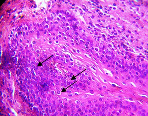 Fig. 7 Células con núcleo picnótico y retraído en estrato basal y espinoso. Cambios coilociticos.