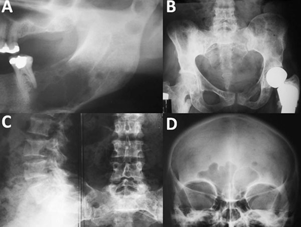 Figura 1 Radiografías panorámica (A), de pelvis (B), de columna vertebral (C) y del cráneo (D), mostrando múltiples lesiones mal definidas radiolúcidas.