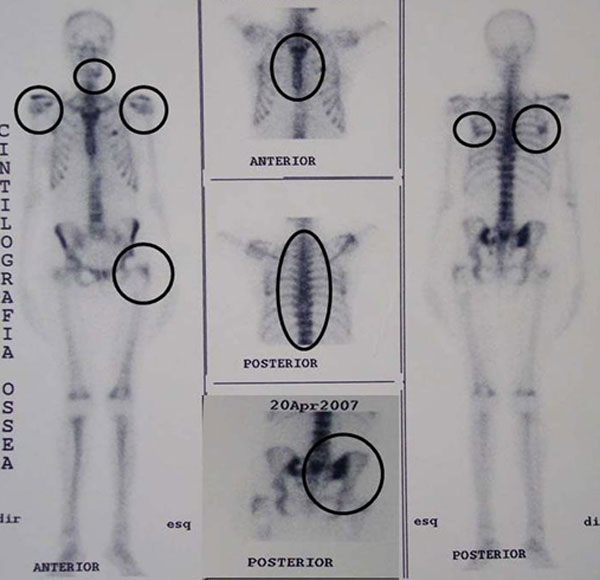 Figura 2 La gammagrafía ósea mostró múltiples áreas de captación del radiotrazador en la mandíbula, la pelvis, la columna vertebral, el cráneo, la clavícula y las costillas.