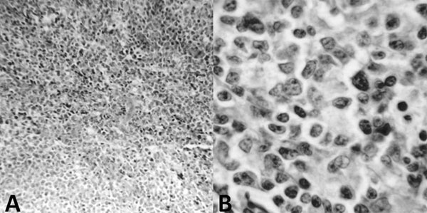 Figura 3 El análisis histológico revela en A y B, la infiltración masiva de células plasmocitoides.