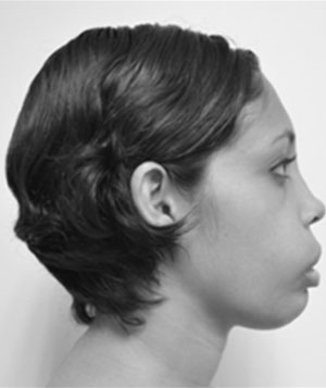Fig. 1 Vista lateral derecha, detalle de la deformidad facial en región cutánea del labio.