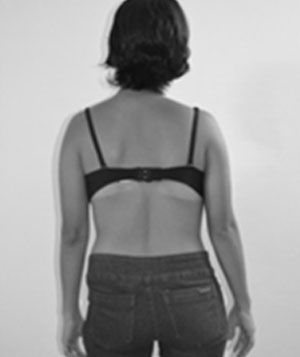 Fig. 2 Vista posterior, detalle de laescoliosis.