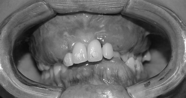Fig. 4 Foto intrabucal