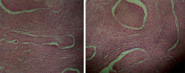 Fig. 6 Microfotografías, se evidencio estroma de tejido conectivo fibroso denso, con áreas mixoides, en el que se identifica, trabeculas de tejido óseo, inmaduro y maduro vital. Cortesía del centro JUMA CA; centro de especialidades odontológicas.