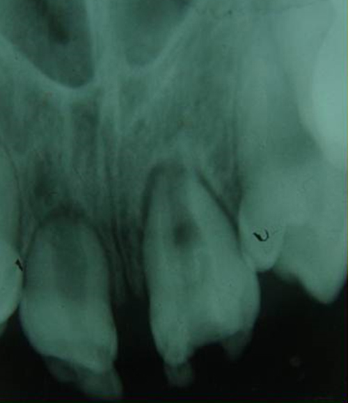 Figura 4 Radiografía Panorámica detectándose las anomalías dentarias presentes.