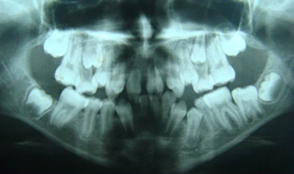 Figura 5 Extensa reabsorción radicular y anomalía de los incisivos centrales inferiores y lateral inferior izquierdo.