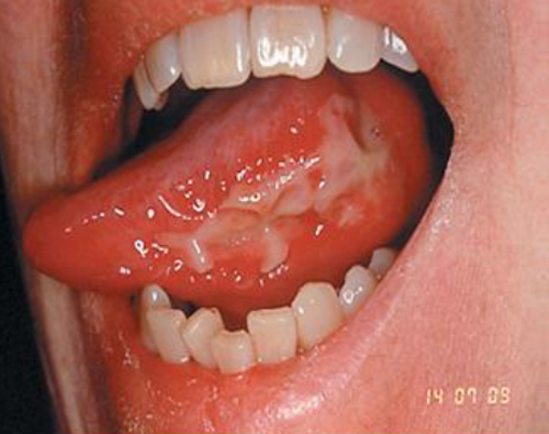 Figura 1 Mucositis en borde lateral de lengua 12.