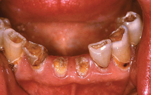 Figura 2 Caries por radiación 8