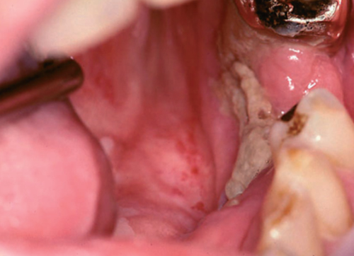 Figura 3 Exposición del hueso mandibular, característico de la osteoradionecrosis.