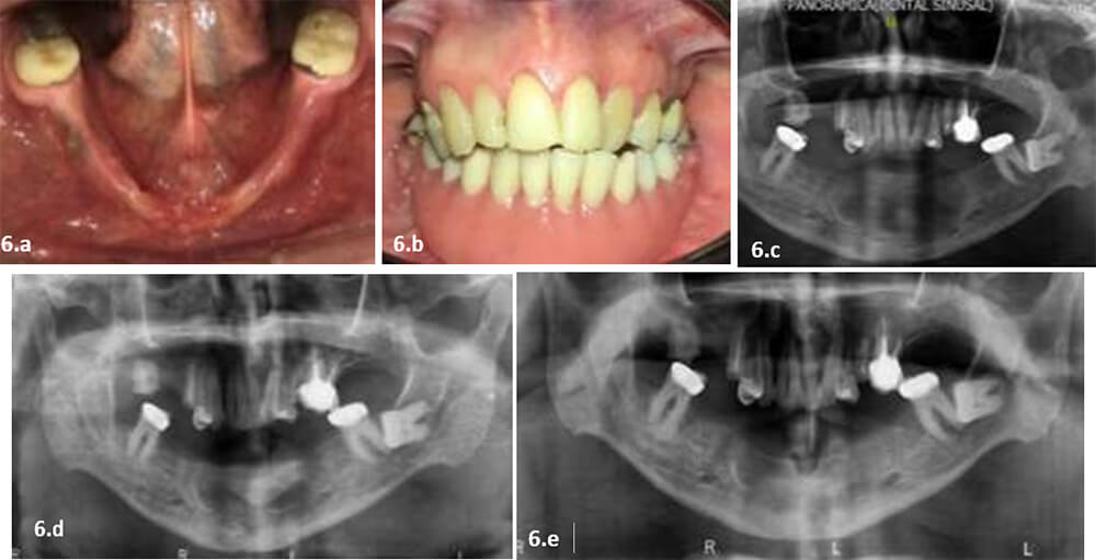 Figura 6. Fotografías postoperatorias (6 meses). a) fotografía intraoral oclusal inferior. b) fotografía en oclusión con prótesis removible. c) radiografía panorámica control a los 3 meses postoperatorios. d) radiografía panorámica control a los 6 meses. e) radiografía panorámica control a los 29 meses. 
