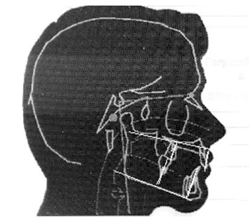 Fig. 7 Movimiento de intrusión o extrusión de incisivos y molares