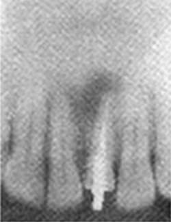 Quiste Periapical: Antes de la operación