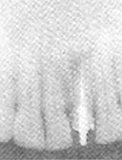 Quiste Periapical: 3 meses después