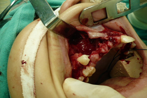 Figura 2 Intraoperatoria del tumor en la enucleación