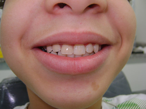 Figura 6 Aspecto final con prótesis dentariaes cosméticas
