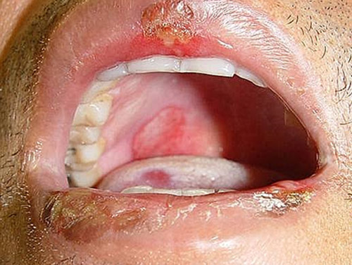 Imagen 1 Observar áreas ulceradas en labio asociadas a la extensa ulceración en paladar blando, con márgenes eritematosas bien definidas.
