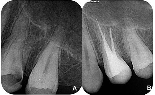 Figura 1 A) radiografía periapical de diagnóstico inicial del elemento dental 24 con lesión de caries en las caras oclusal y distal, observándose la presencia de tres raíces. B) Radiografía periapical final de la obturación de los conductos radiculares mostrando tres raíces y tres conductos radiculares.