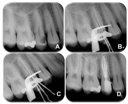 Figura 2 A) Radiografía periapical para diagnóstico mostrando lesión de caries en las superficies mesio y oclusal del diente número 15, sospechando la presencia de múltiples raíces y conductos radiculares. B) Radiografia periapical de exploración, demostrando dos conductos radiculares. C) Radiografía periapical conductometría mostrando la presencia de tres conductos radiculares, siendo dos vestibulares y un palatino; D) Radiografía periapical de la obturación final.