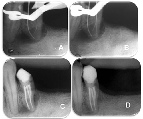 Figura 3 A) Radiografía periapical que muestra la exploración de los conductos radiculares del elemento 44. B) Radiografía periapical de conductometría mostrando la presencia de tres conductos radiculares. C) Radiografía periapical de la obturación final. D) Radiografía periapical de preservación un año después de terminar el tratamiento.