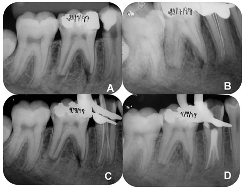 Figura 4 A) Radiografía periapical para diagnóstico del elemento 35, mostrando fractura e infiltración de la restauración del tipo clase II. Presencia de raíces múltiples. B) Radiografía periapical de exploración de los conductos radiculares que muestra 2 conductos radiculares con posibilidad de un tercero canal. C) Radiografía periapical de la conometría mostrando 3 conductos radiculares. D) Radiografía periapical de la obturación final.