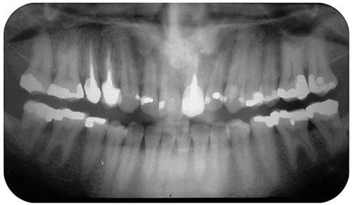 Figura 1 Radiografía panorámica mostrando cámaras y cuernos pulpares aumentados en los molares superiores e inferiores.