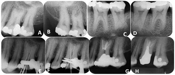 Figura 2 A - Radiografía periapical. Dientes 26 (hipertaurodontismo) y 27 (mesotaurodontismo). B- Dientes 16 (mesotaurodontismo) y 17 (hipertaurodontismo). C- Dientes 36 (hipotaurodontismo) y 37 (mesotaurodontismo). D- Dentes 46 (mesotaurodontismo) y 47 (mesotaurodontismo). E- Radiografía periapical diente 26. Determinación de la odontometría. F- Determinación de Conometria diente 26. G - Radiografía periapical, compactación diente 26. H - Radiografía periapical, control de 2 años diente 26.