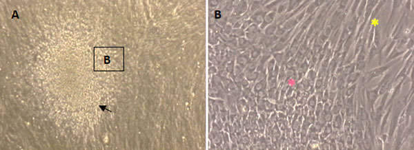 FIGURA 3 Cultivo de células mesenquimales de pulpa dentaria humana en monocapa. Sexto subcultivo: A. Formación de agregado celular (flecha).40x; B. Células de la periferia del agregado con morfología fusiforme (*) y hacia el centro células estrechamente agrupadas cuboides (*).Contraste de fase. 100x