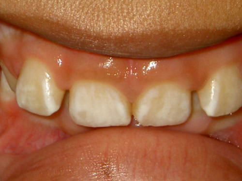 Foto 1 Hipoplasia de esmalte generalizada