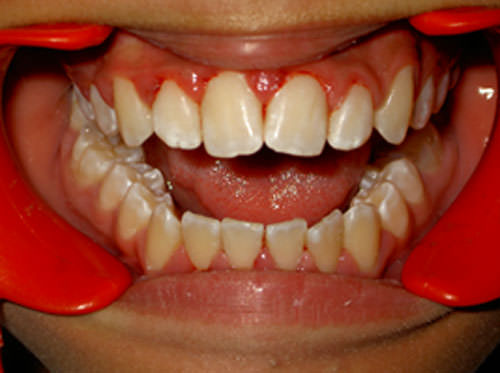 Foto 3 Hipoplasia de esmalte y gingivitis
