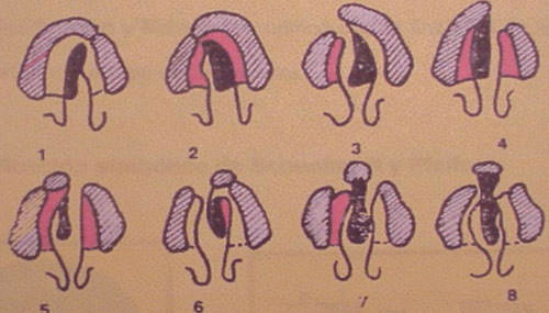 Fig.3 Fisuras labio-alvéolo-palatinas Fuente: CIAPA Facultad de Odontología. UCV