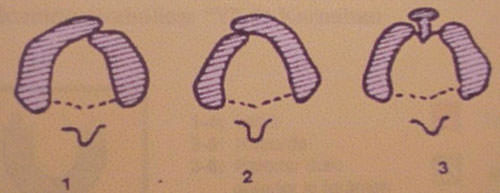 Fig.4 Fisuras alveolares Fuente: CIAPA Facultad de Odontología. UCV