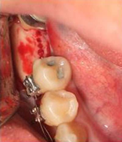 2. Realización de perforaciones consecutivas sobre la cortical de M a D, en sentido apical hasta hueso esponjoso.