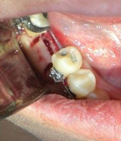 3. Se crean unas líneas de fractura longitudinal sobre el alveolo de los dientes vecinos.