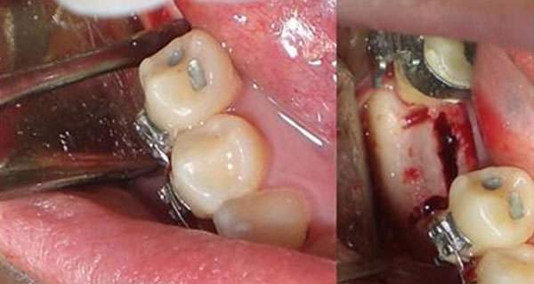 4. Separación las tablas flejándolas lentamente hacia vestibular o lingual hasta lograr la expansión deseada del corredor óseo.