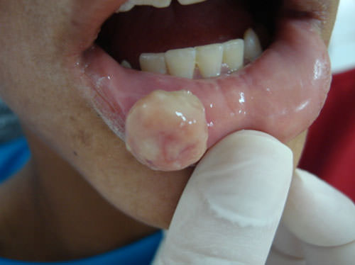 Figuras 1 y 2 Lesión de leiomioma en el labio inferior, con aspecto clínico similar al fibroma traumático de 2 cm de diâmetro y de color pálido que interfiere en la masticación del paciente.