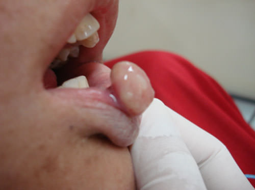 Fig. 3 Lesión de base pediculada