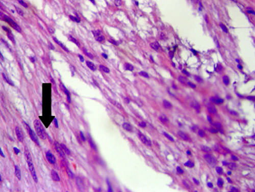 Fig. 5 Células fusiformes semejantes a fibras musculares lisas