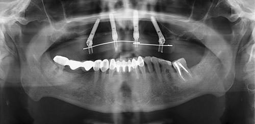 Fig.8 Radiografía postoperatoria