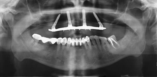 Fig.10 Radiografía 6 meses después con prótesis definitiva.