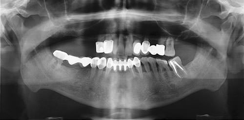 Fig.2 Radiografía panorámica preoperatoria